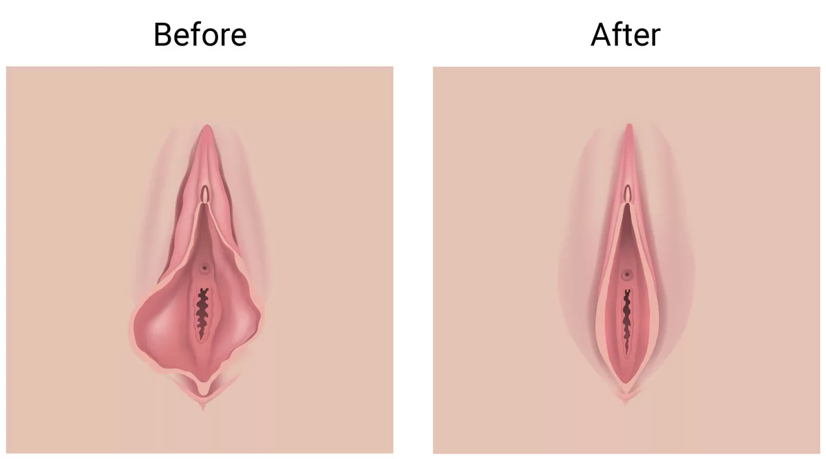 Labiaplasty (1)