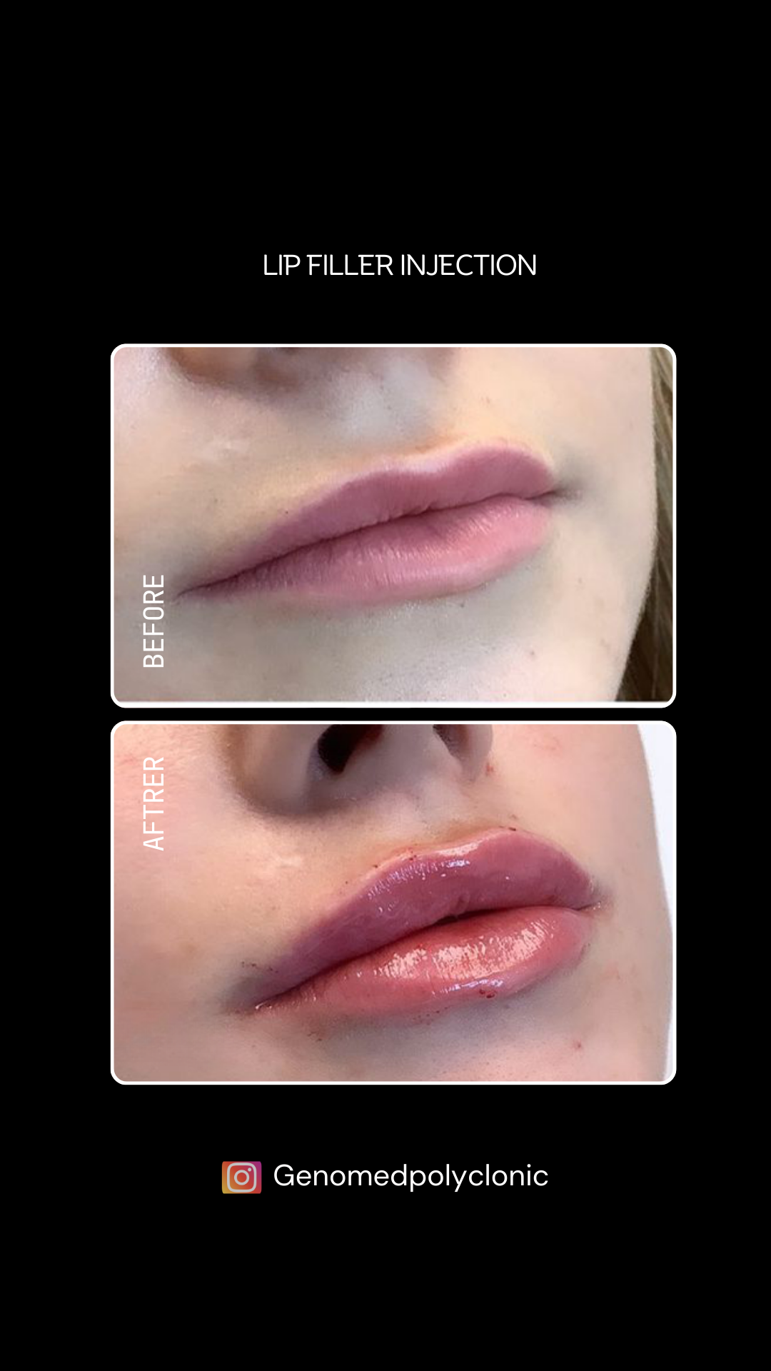 lip-filler-result