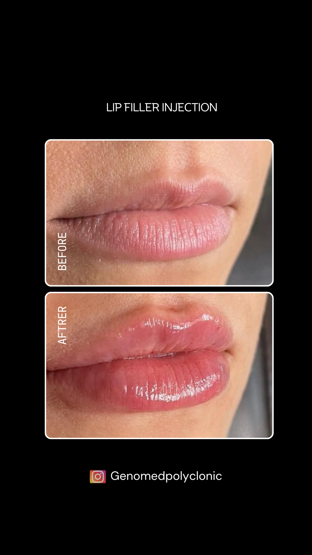 lip_filler