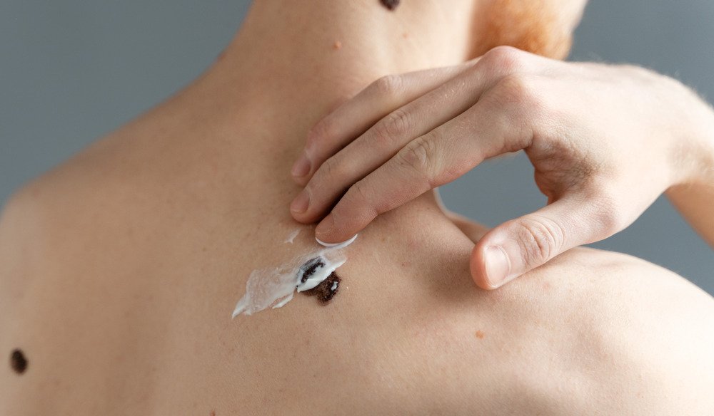 skin tag removal