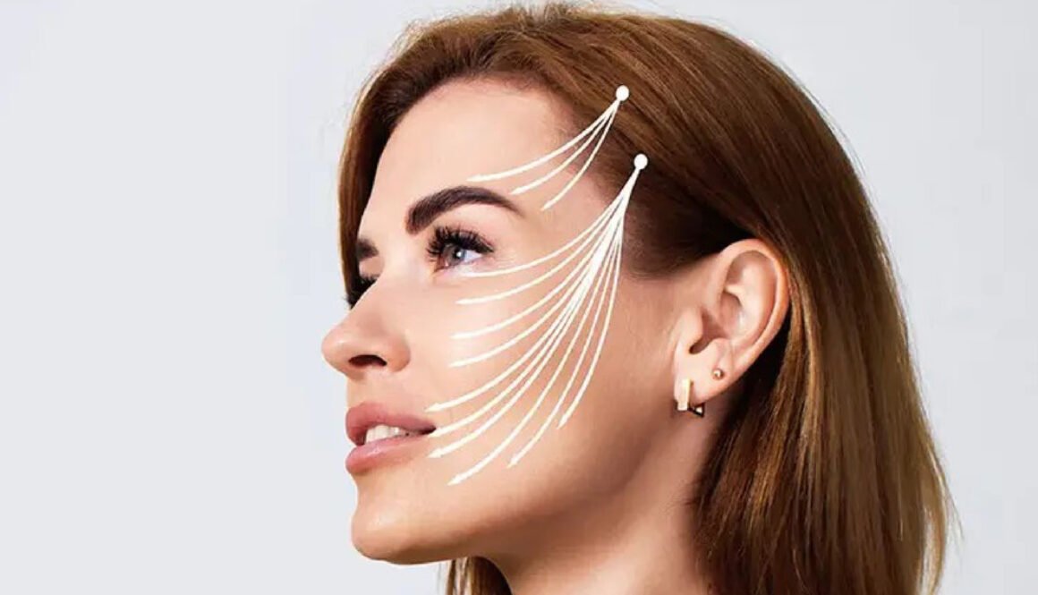 thread lift treatment