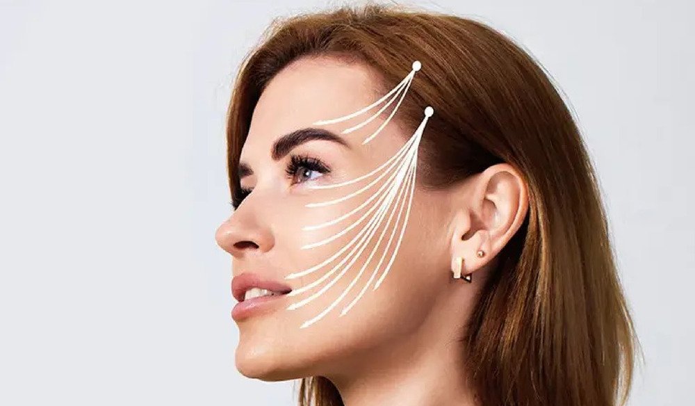 thread lift treatment