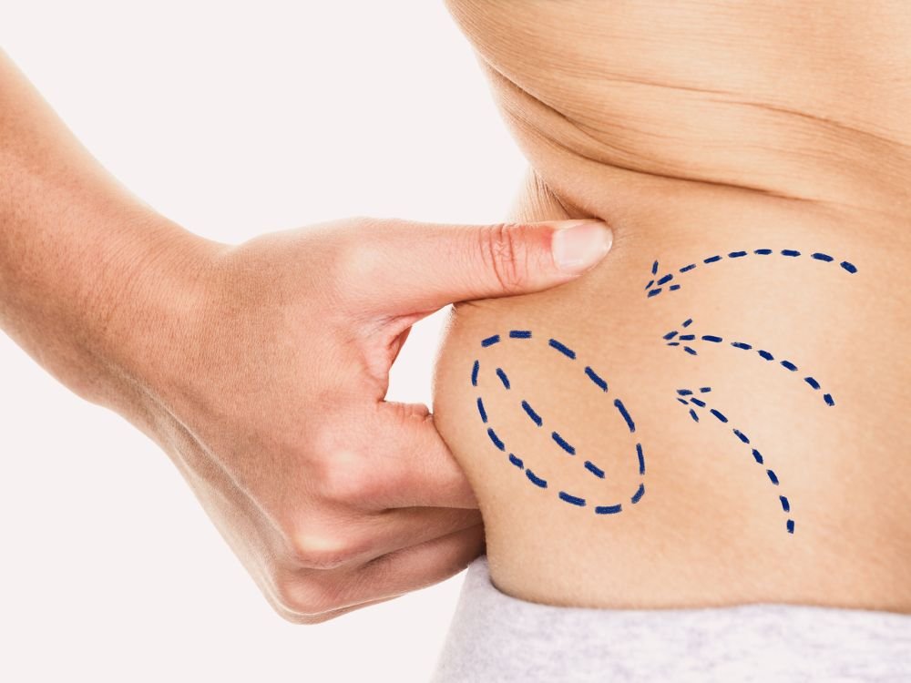 liposuction treatment