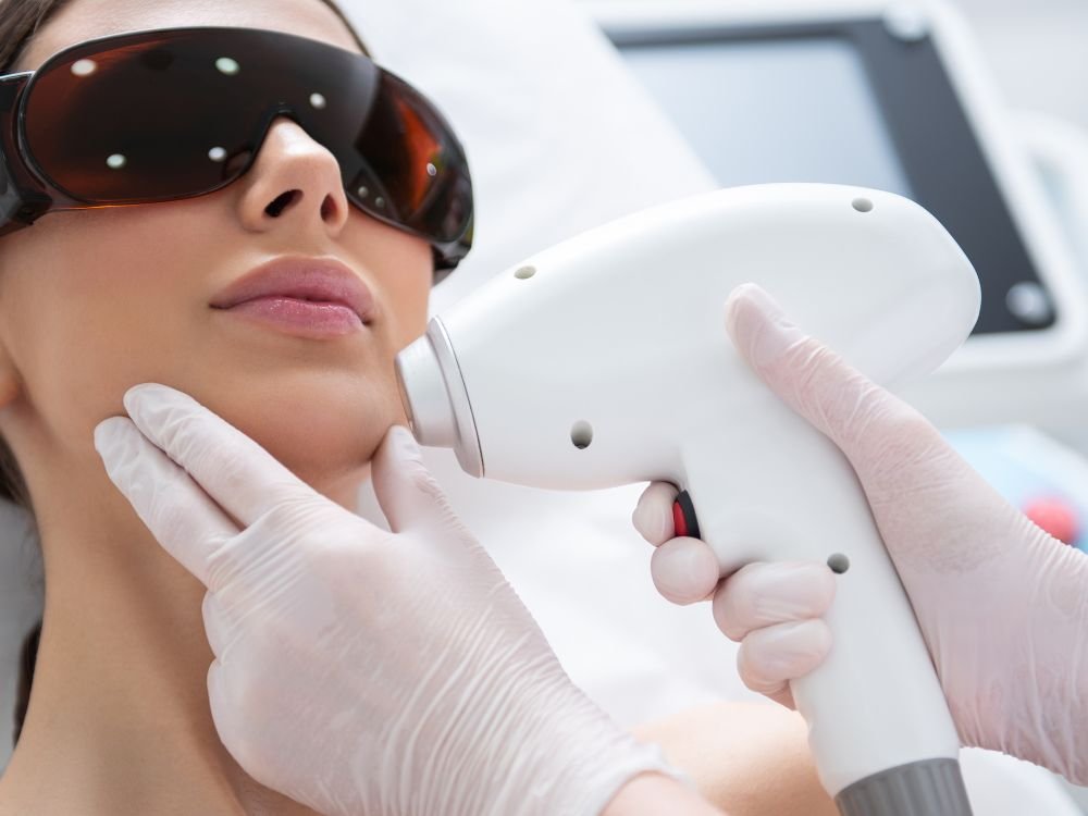 laser hair removal