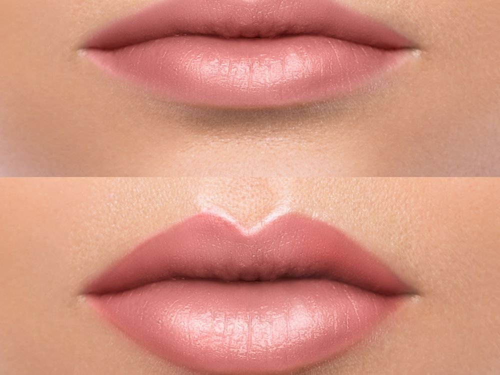 Lip augmentation in Dubai