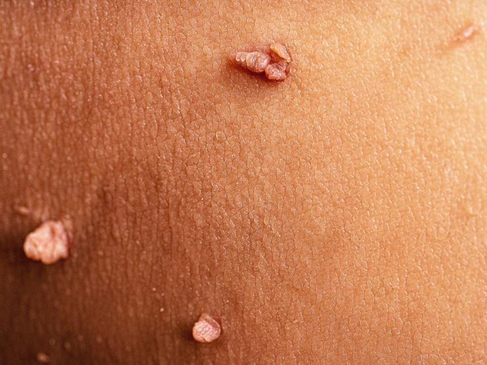 Skin tag removal in Dubai