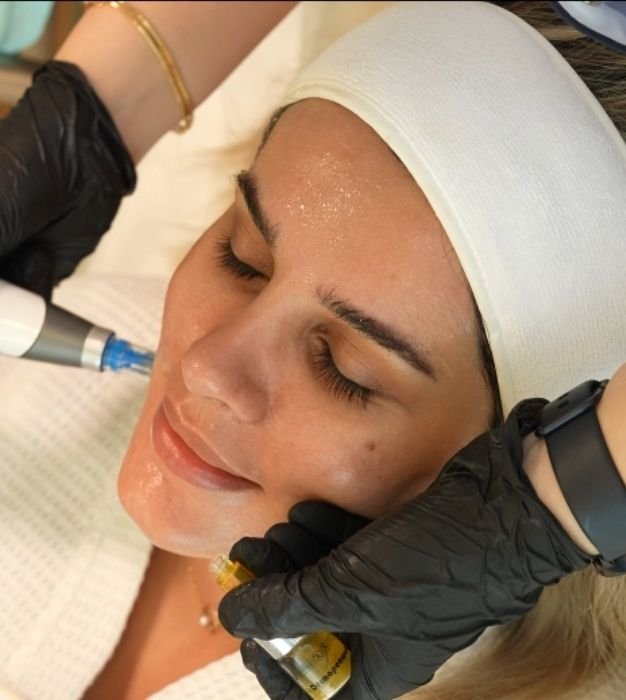 Smoother skin with exclusive microneedling offers in dubai