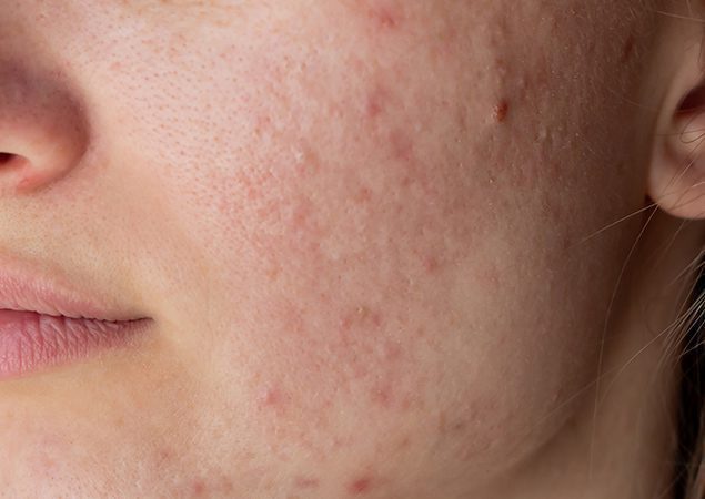 Ultherapy HIFU machine applied to patient’s face Ultherapy HIFU machine applied to patient’s face