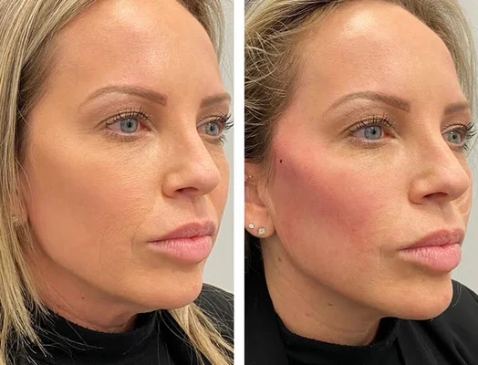 Thread Lifting for Face Contour Dubai