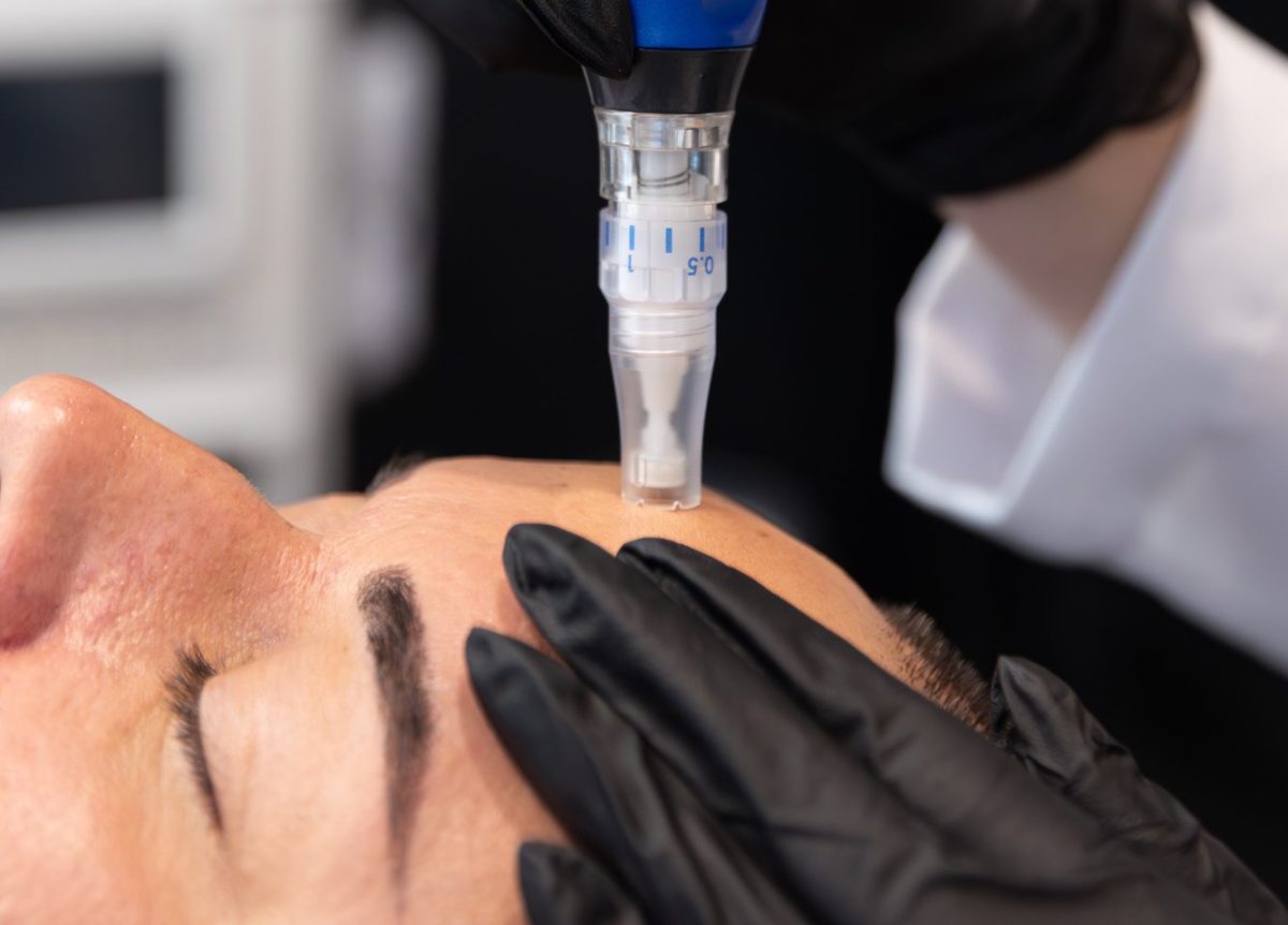 Skin rejuvenation through microneedling in Dubai