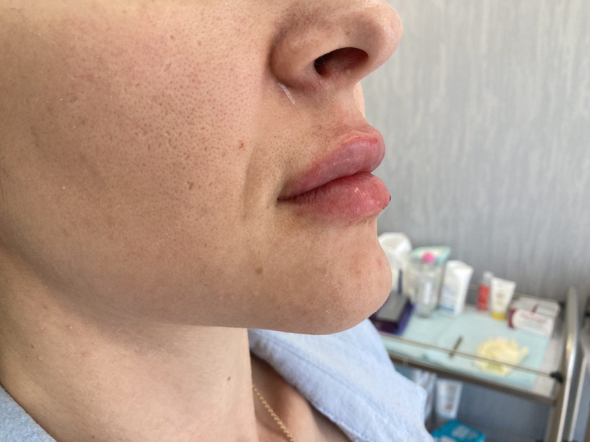 Before and after lip enhancement results"