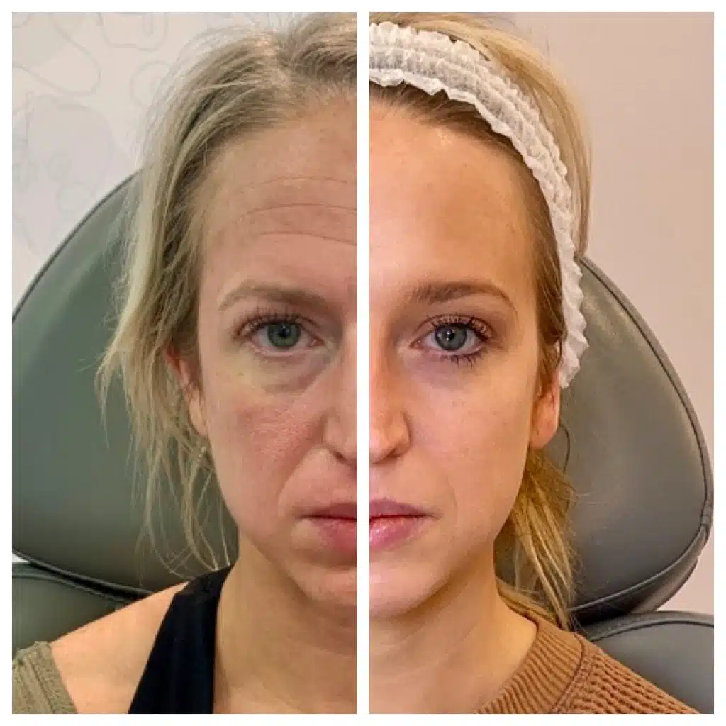 Before and after Sculptra results