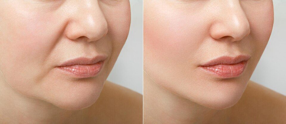 Before and after dermal filler results at Genomed Clinic