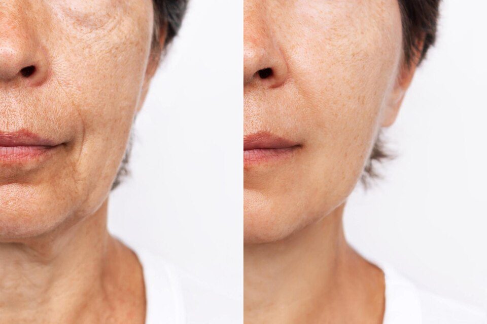 Before and after results of skin booster therapy