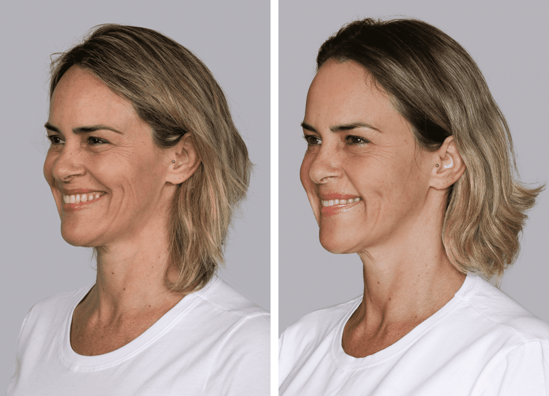 Collagen stimulation with Sculptra injections