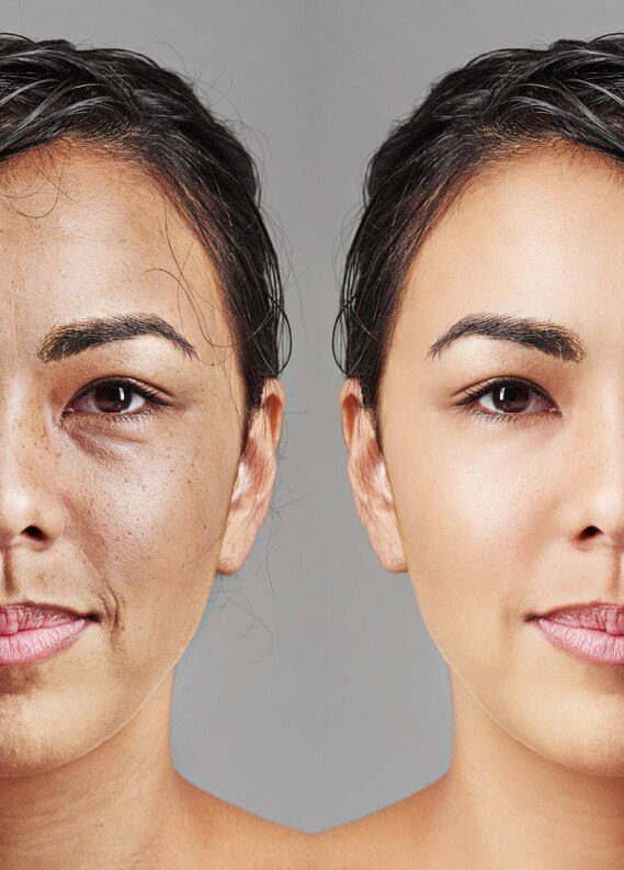 Before and after microneedling results in Dubai clinic