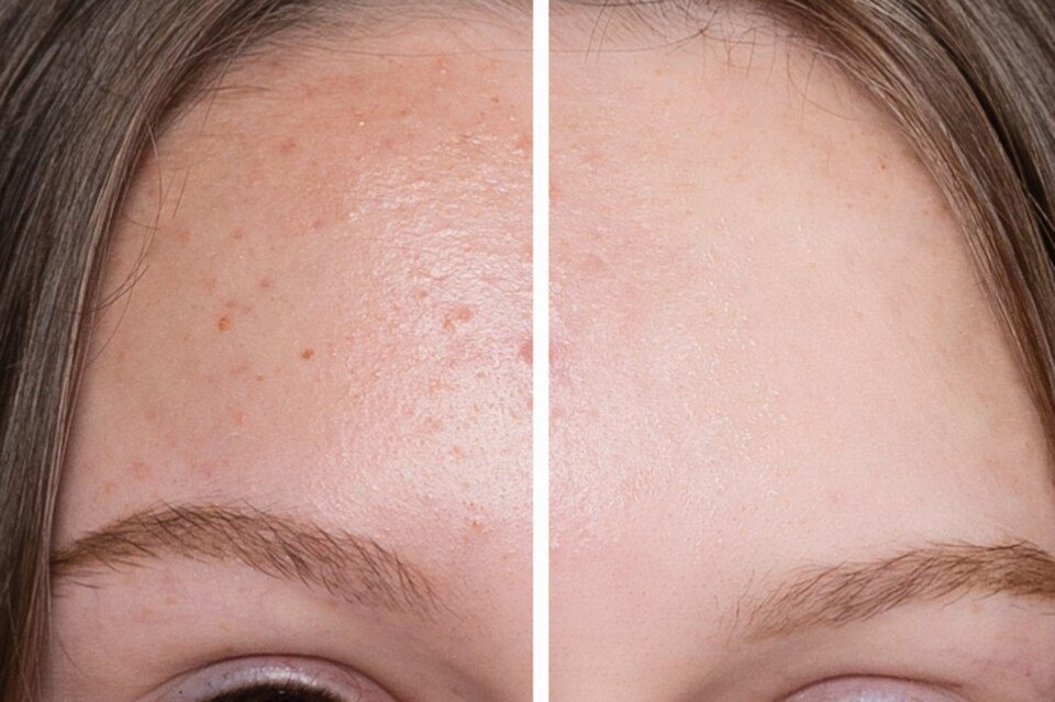 Certified aesthetician administering HydraFacial procedure in Dubai clinic