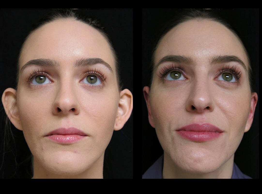 Happy client showcasing lip filler results