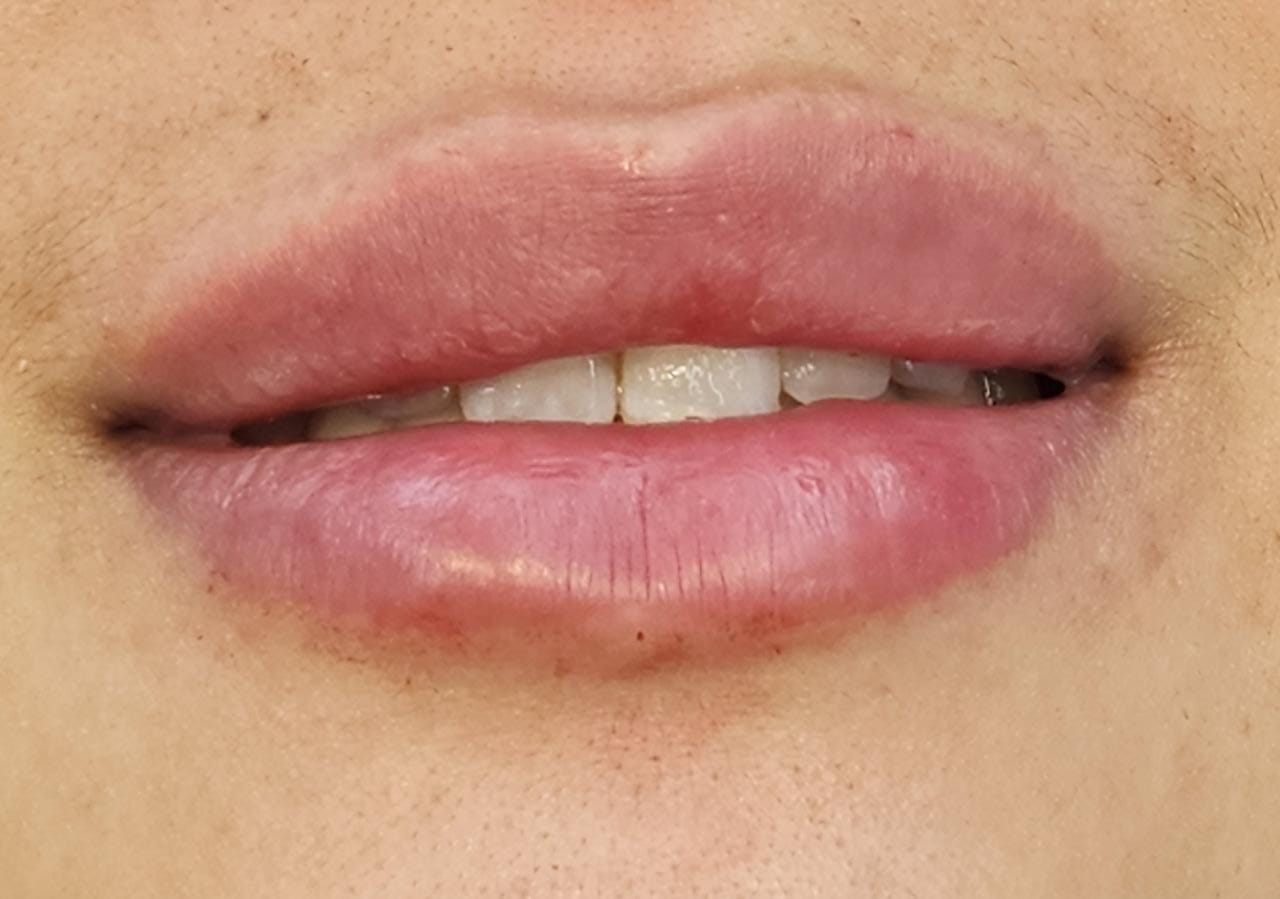 Close-up of symmetrical, plump lips post-treatment