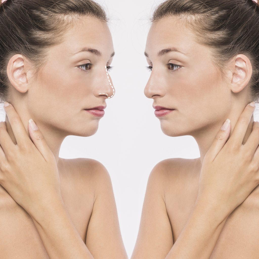 Close-up of skin tightening results after VRF treatment