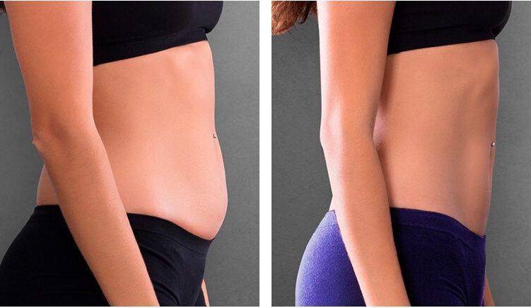 Woman receiving V10 body contouring on abdomen at Genomed Dubai