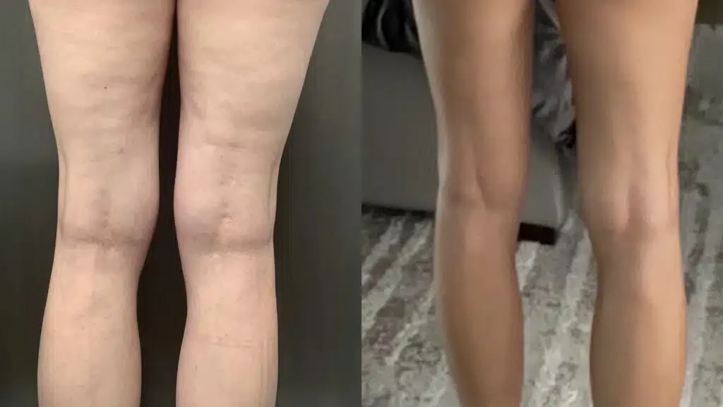 DHA-certified specialist performing RF contouring