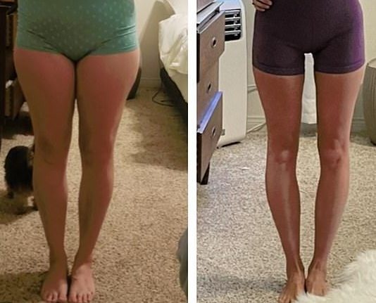 Before and after leg slimming treatment at Genomed Polyclinic Dubai – non-surgical fat reduction and contouring for slimmer thighs