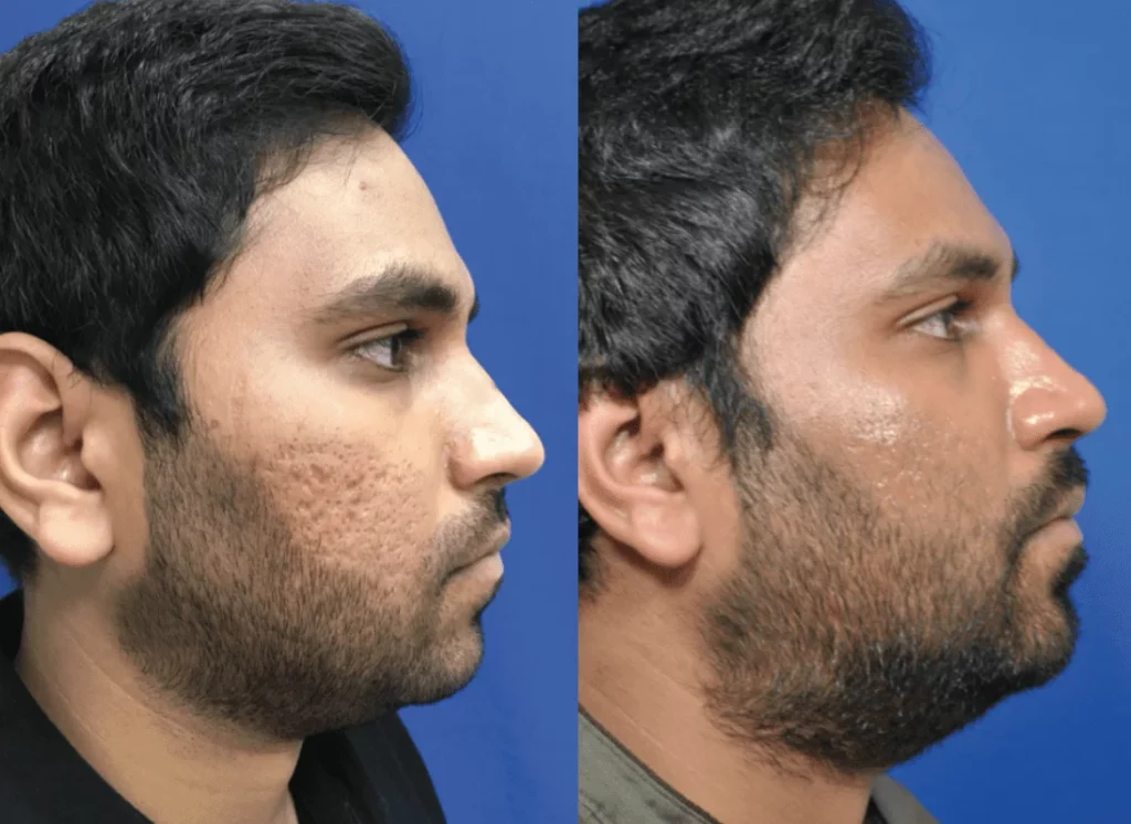 Before and after of microneedling facial for smoother skin