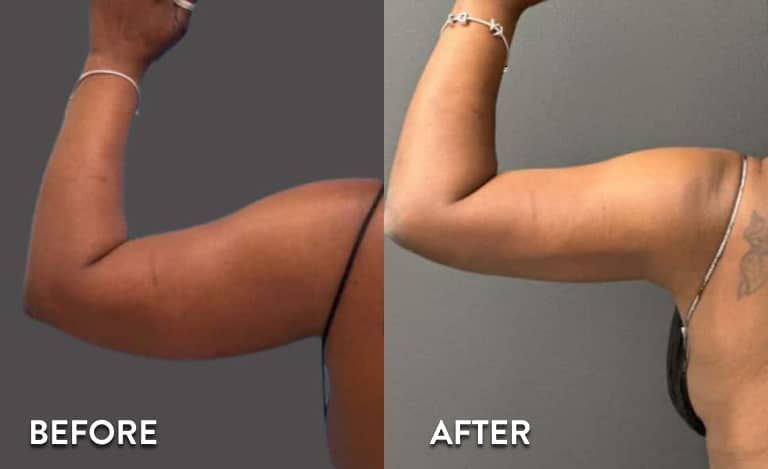 Before and after slimming results in Dubai clinic