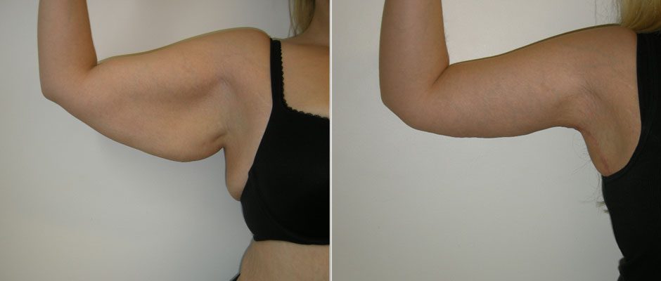 Before and after belly fat reduction from cavitation sessions