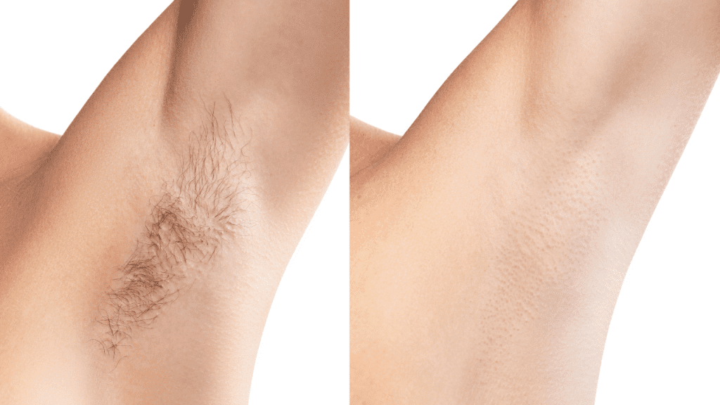 Female client receiving underarm laser hair removal in Dubai clinic