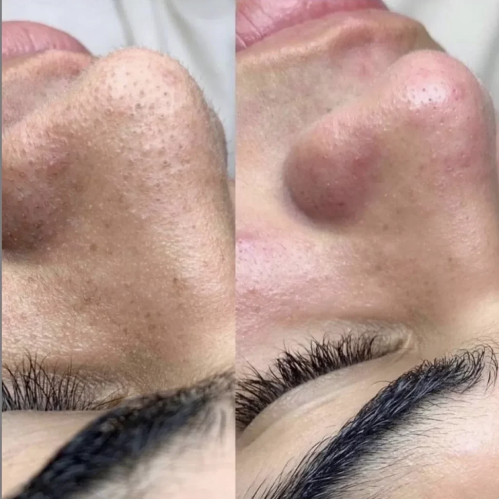 Hydrafacial treatment being performed at Genomed Polyclinic