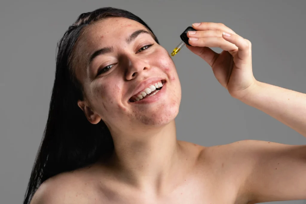 Smiley young woman being confident with her acne and treating it