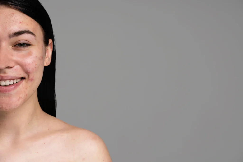 Young woman showing her acne with confidence